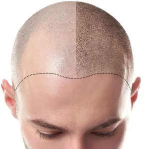 Scalp Micropigmentation in London