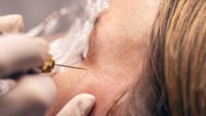 Plasma Fibroblast London