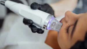 RF Microneedling London