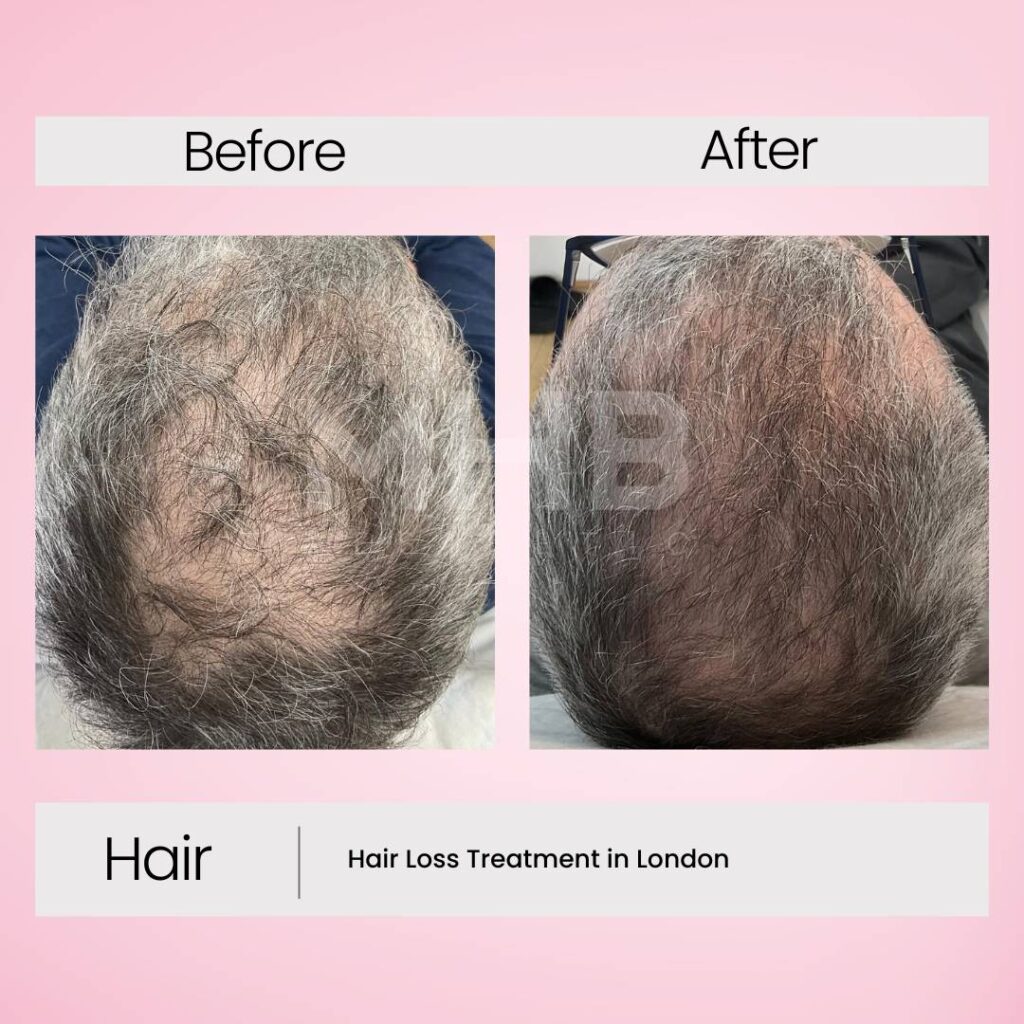 Hair loss treatment in London