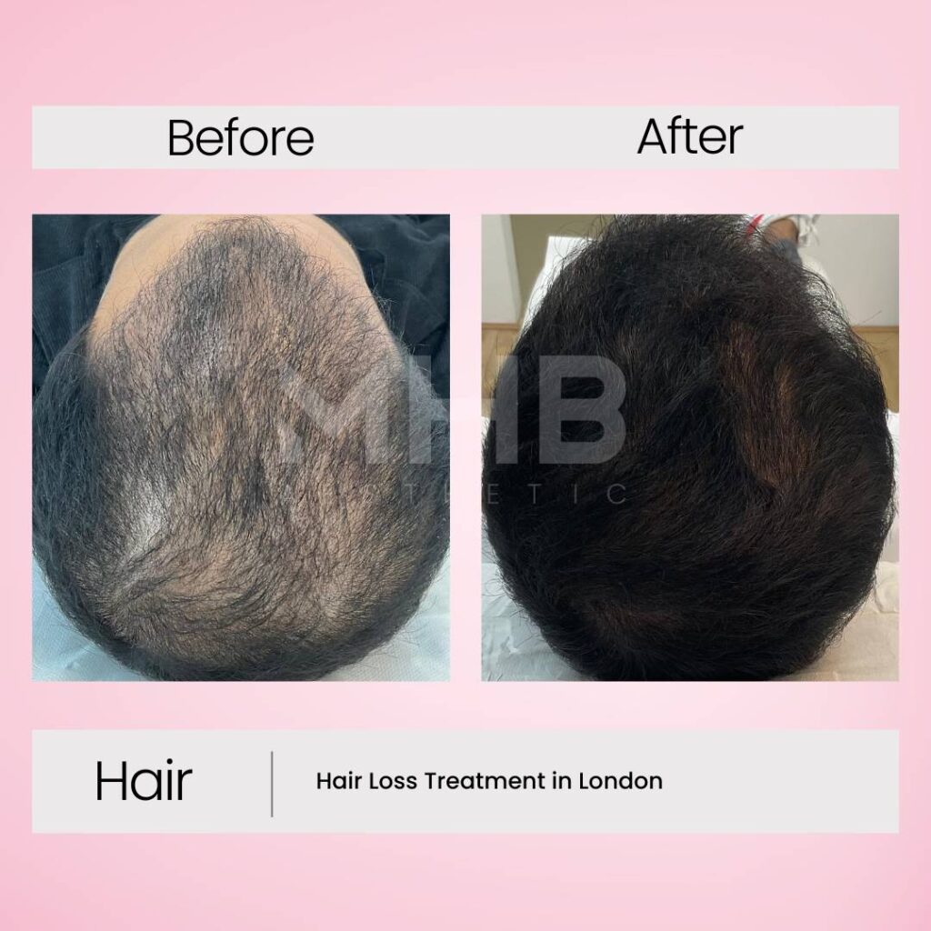 Hair loss treatment in London 6
