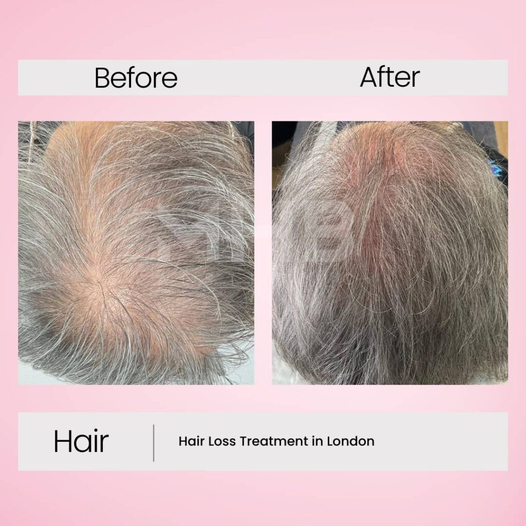 Hair loss treatment in London 8