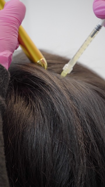 PRP Treatment in London - Hair Treatment