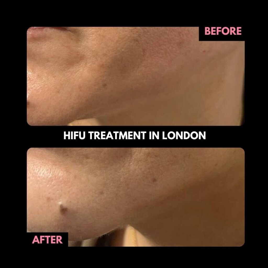 Hifu Treatment in London Before and After