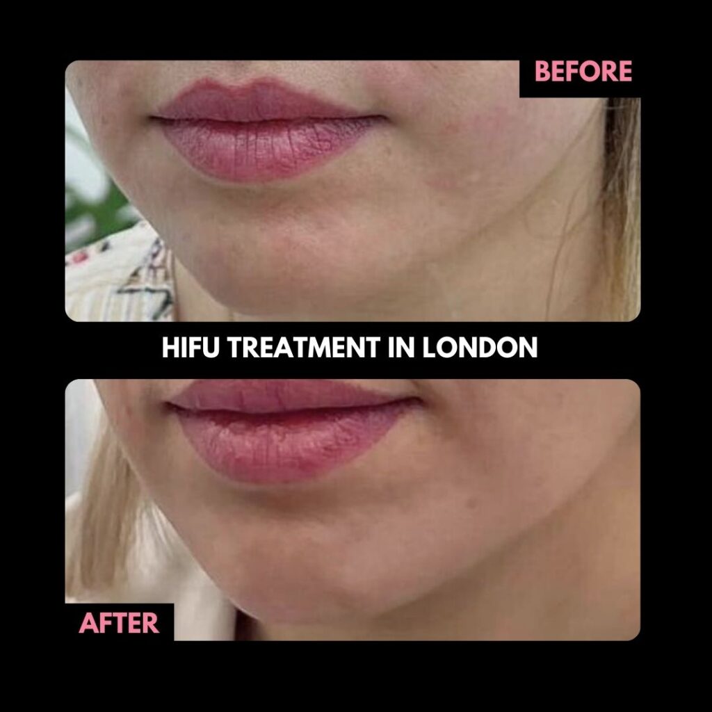 Hifu Treatment in London Before and After