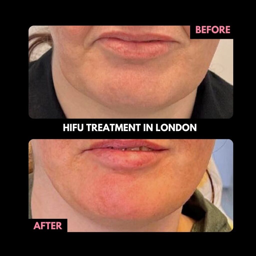 Hifu Treatment in London Before and After